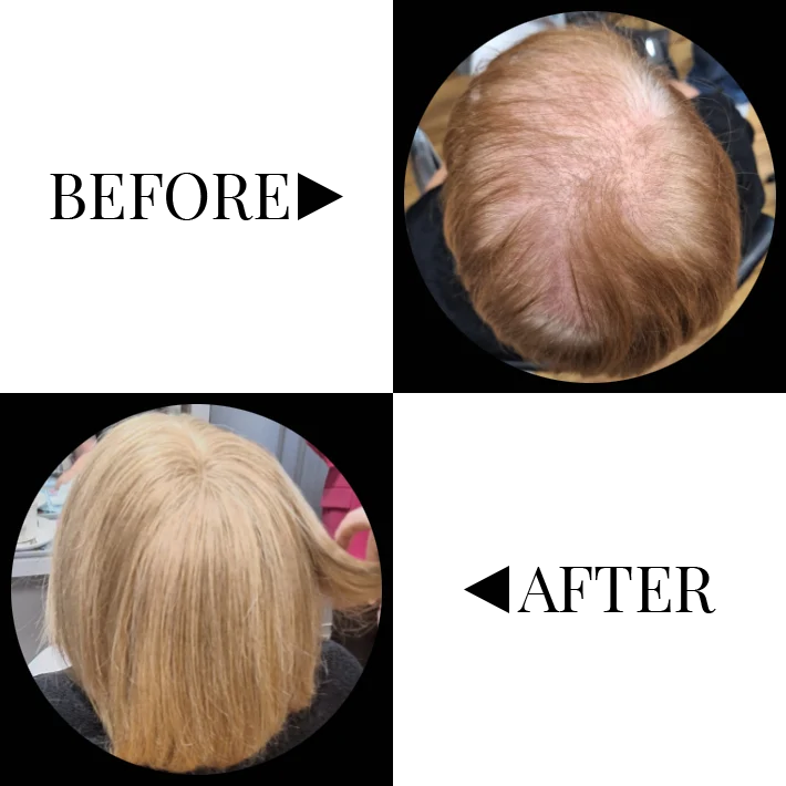 before and after of a client with hair restoration